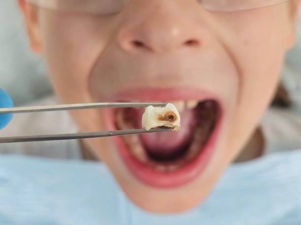 Best Emergency Root Canal Therapy in Nellysford, VA